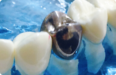 金銀パラジウム合金(銀歯)