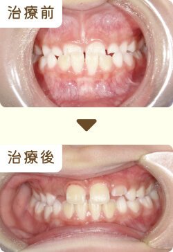 子どもの矯正治療イメージ(1)